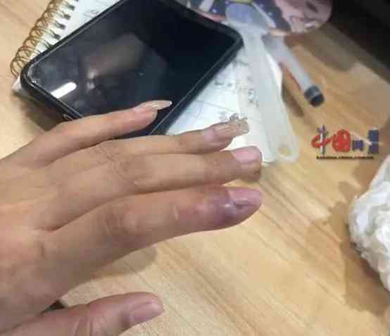  女子因拔倒刺引发骨髓炎，或面临截肢风险