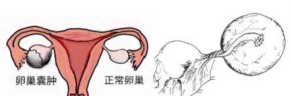 暑假骑马带来的意想不到的健康危机,女子被紧急手术保命