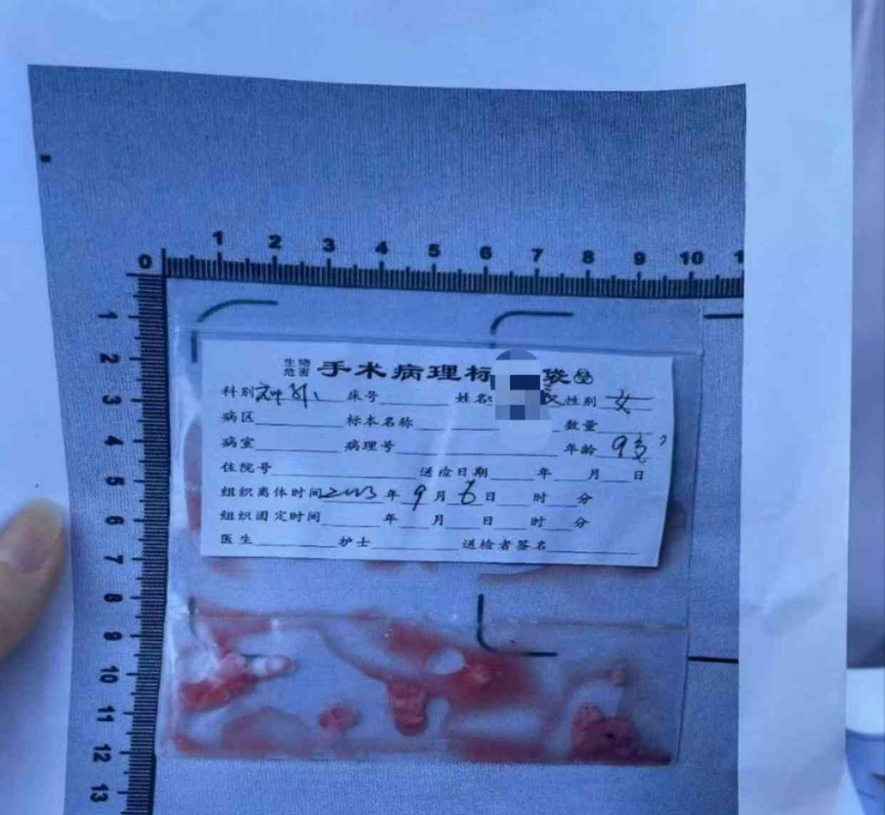 小学教师打破学生头骨!停职调查现场疑云引发热议