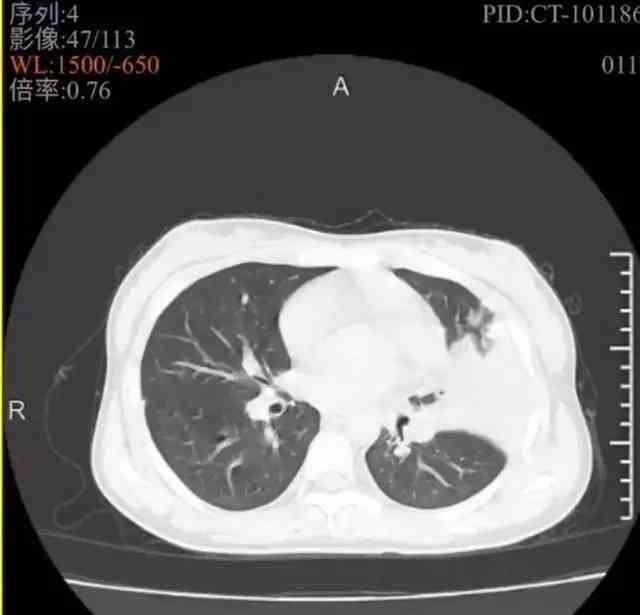 绍兴11岁女孩发烧、咳嗽一周,竟是肺炎支原体感染