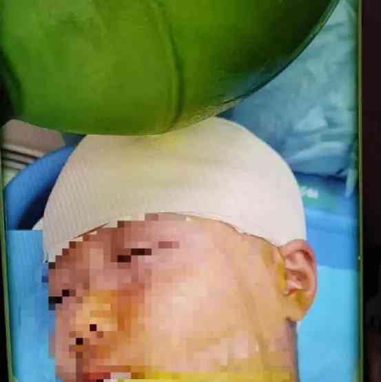 湖南女学生被老师三角尺打伤,开颅手术救治情况危急