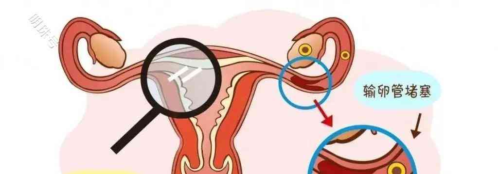 女性不孕原因曝光,细菌侵袭或致输卵管堵塞!