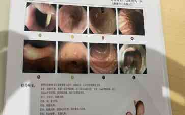 61岁老人胸痛就医,医生惊喜地发现竟是一根鸡骨头!