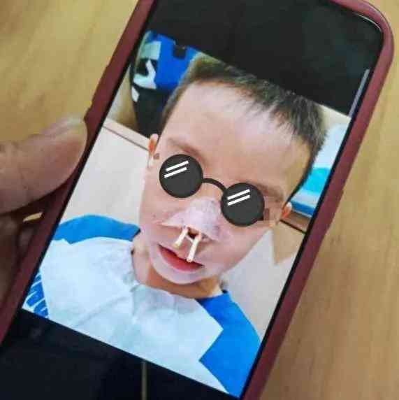 长沙儿童治鼻炎致鼻腔糜烂 医生称用药腐蚀鼻甲