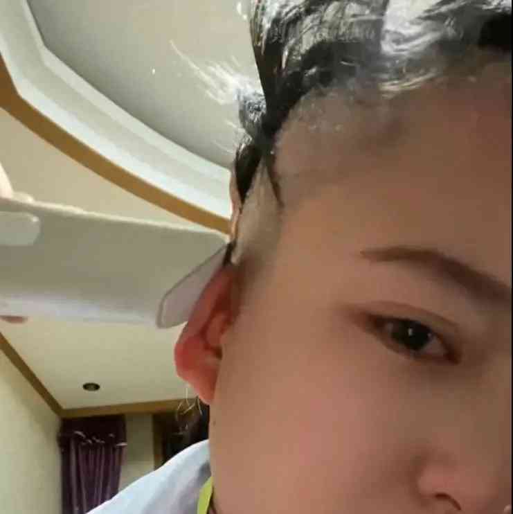 西安女子染发不慎感染银屑病,剃光头面对治疗难题