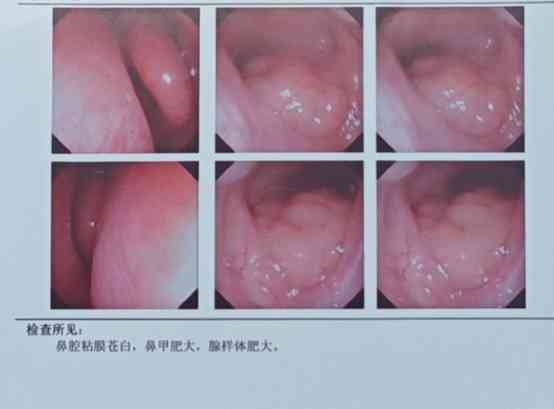 "6岁宝宝鼻炎久治不愈,手术成救命稻草"