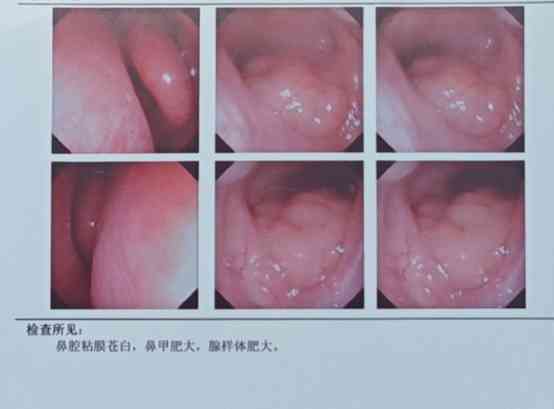  "6岁宝宝鼻炎久治不愈，手术成救命稻草" 