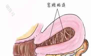  宫腔粘连：身体的“信号” 