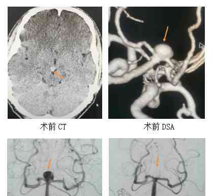  首例后循环基底动脉瘤介入栓塞术成功实施